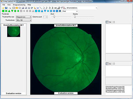 Diabetic Retinopathy Screening Module. Presentation of the retinal image in a red-free mode.